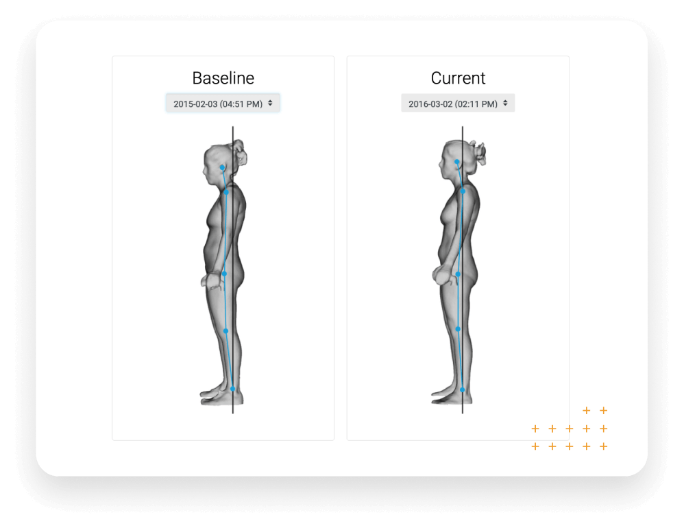 3D body scan comparison showing posture improvement over time